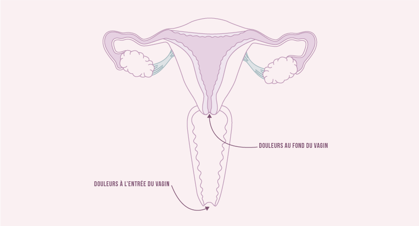 schéma-dyspareunie