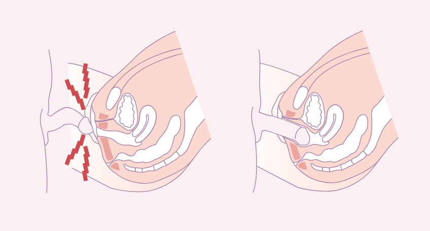 schema-penetration-vaginisme