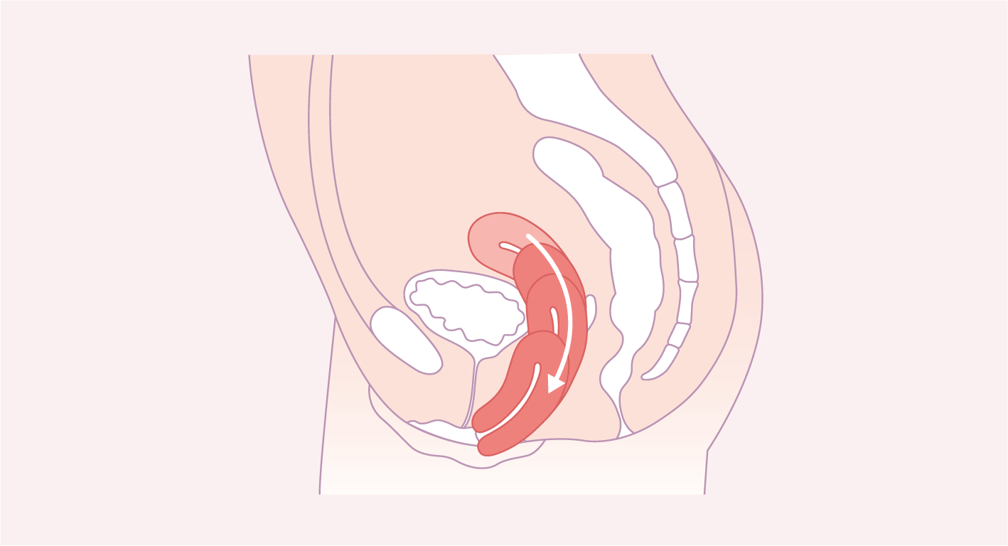 descente d'organes solution