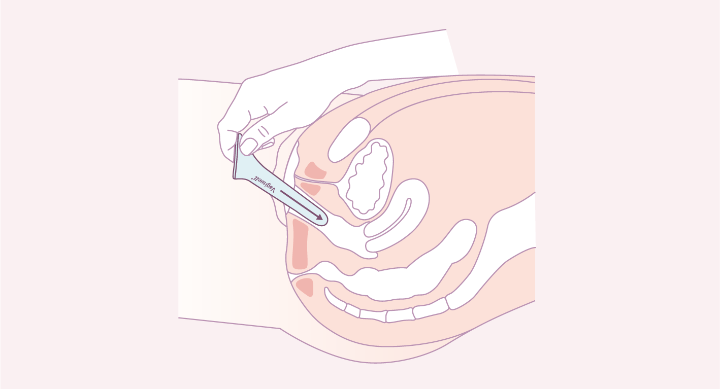 Insertion dilatateur vaginal