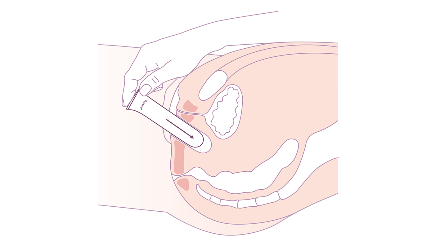 Soigner le vaginisme avec les dilatateurs | Vaginisme-Dyspareunie.fr